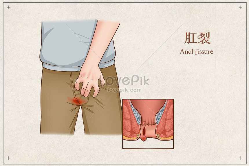 Anal Fissure Treatment and Care