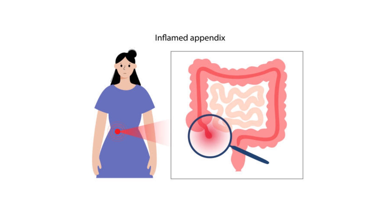Appendicitis Treatment