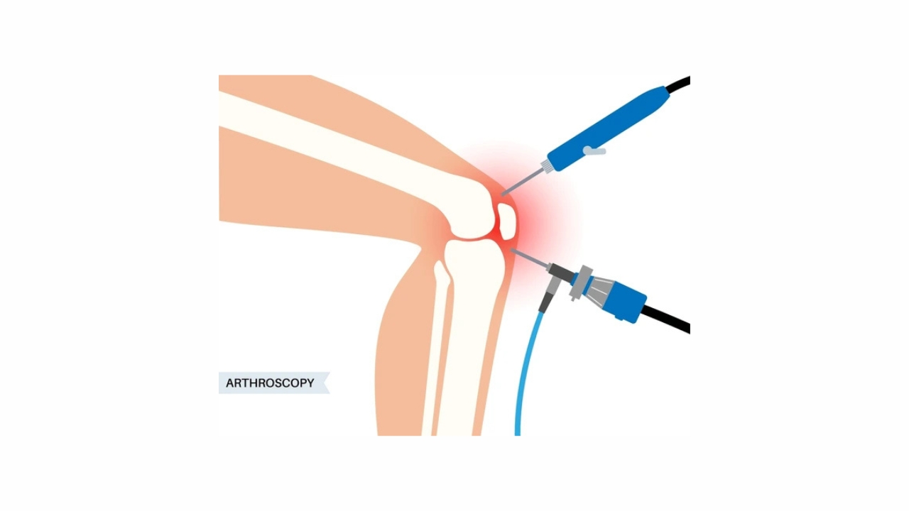 Arthroscopy Surgery
