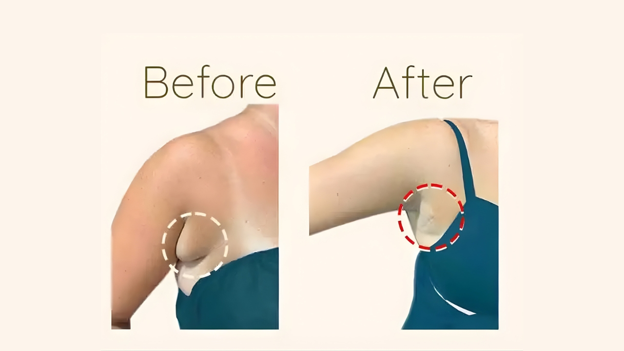 Axillary Breast Treatment Guide