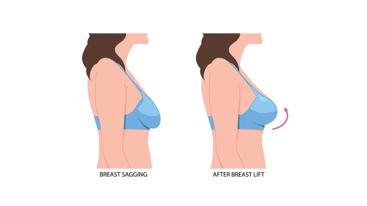 Breast Lift Surgery Guide