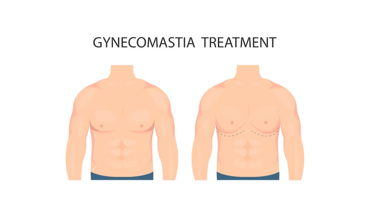Gynecomastia Treatment Guide