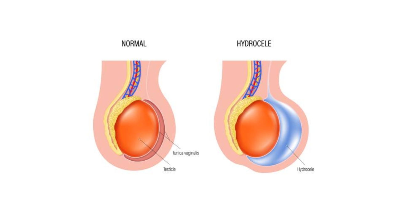 Hydrocele Treatment