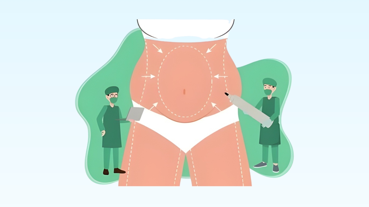 Liposuction Procedure Illustration