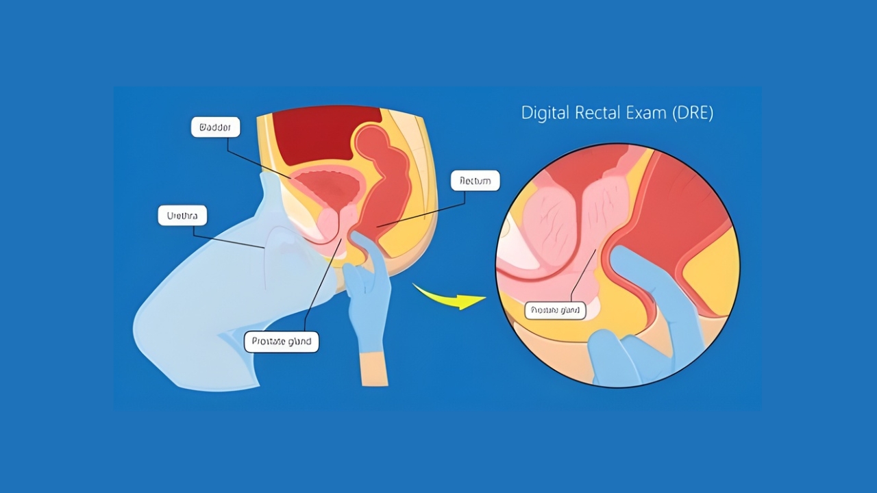 Prostate Surgery and Recovery