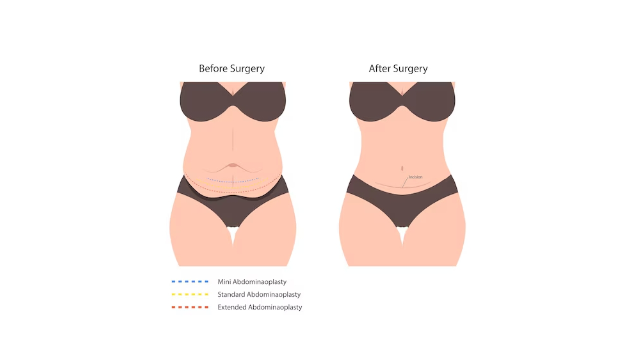 Tummy Tuck Surgery Guide
