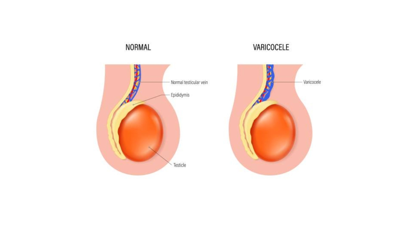 Varicocele Diagnosis and Treatment