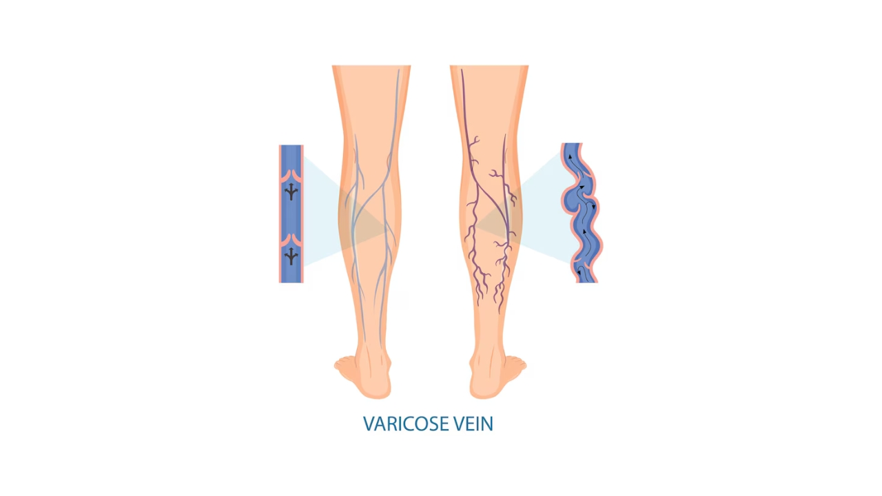 Varicose Veins Treatment