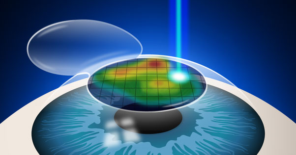 Contoura Vision Topography-Guided LASIK