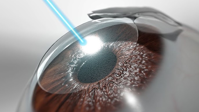 PRK LASIK Procedure for Thin Cornea