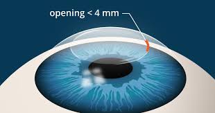 SMILE LASIK Procedure for Vision Correction