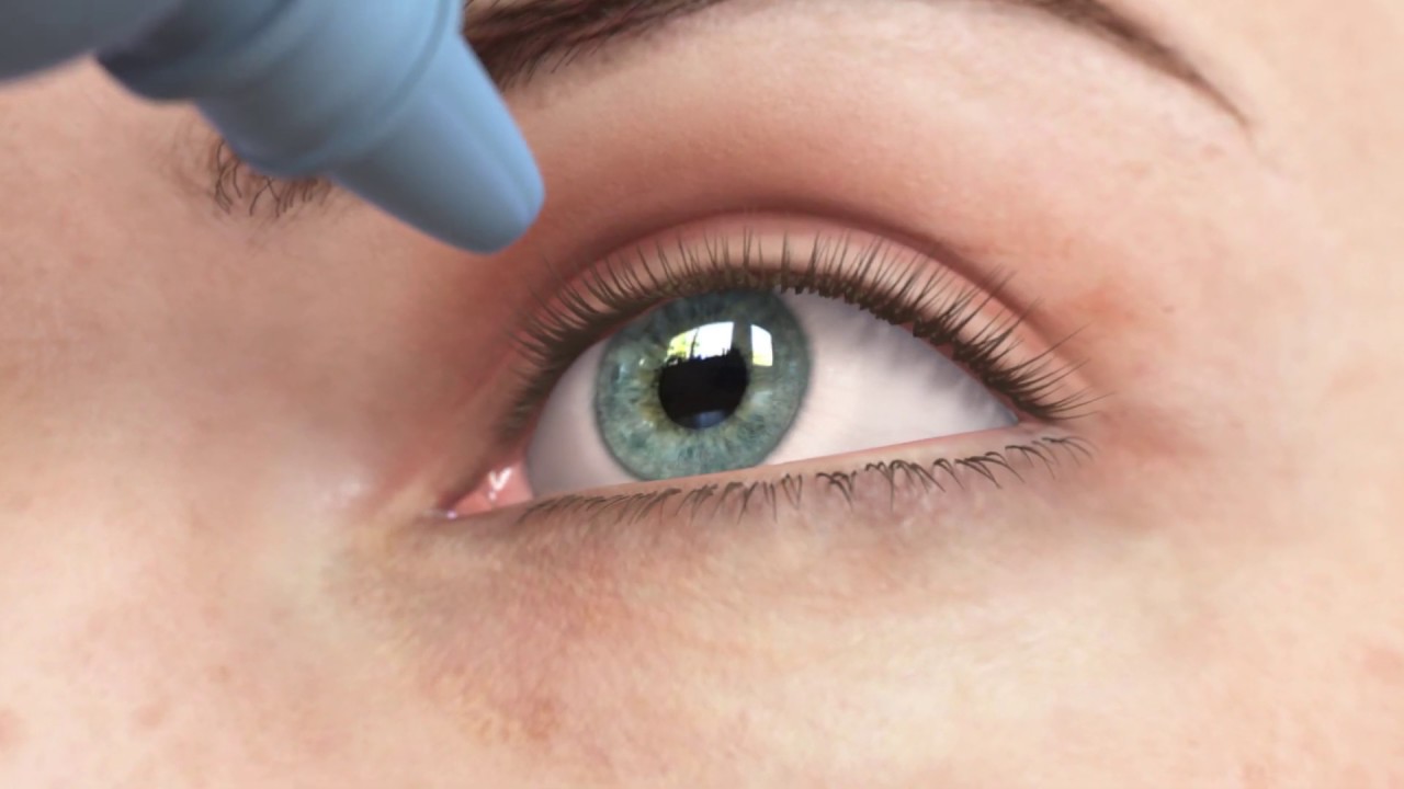 ICL Surgery - Implantable Collamer Lens